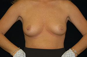 Breast Augmentation 7a